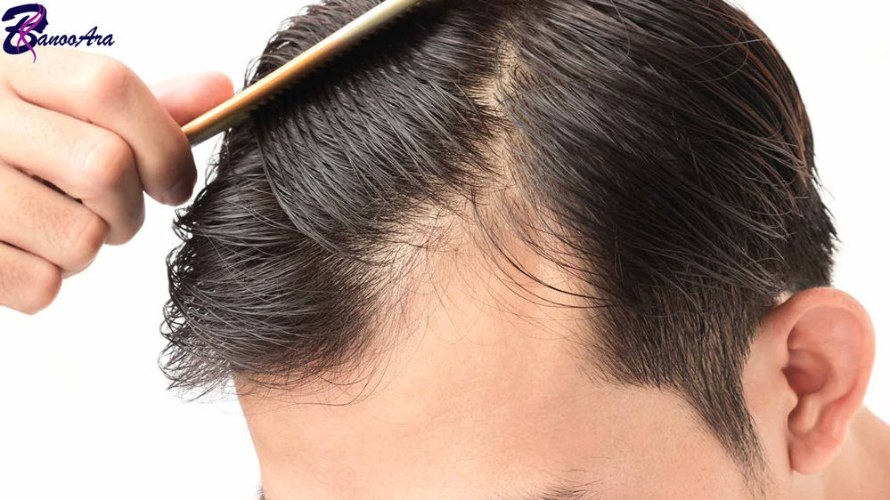 علائم و نشانه‌های ریزش موی سکه ای