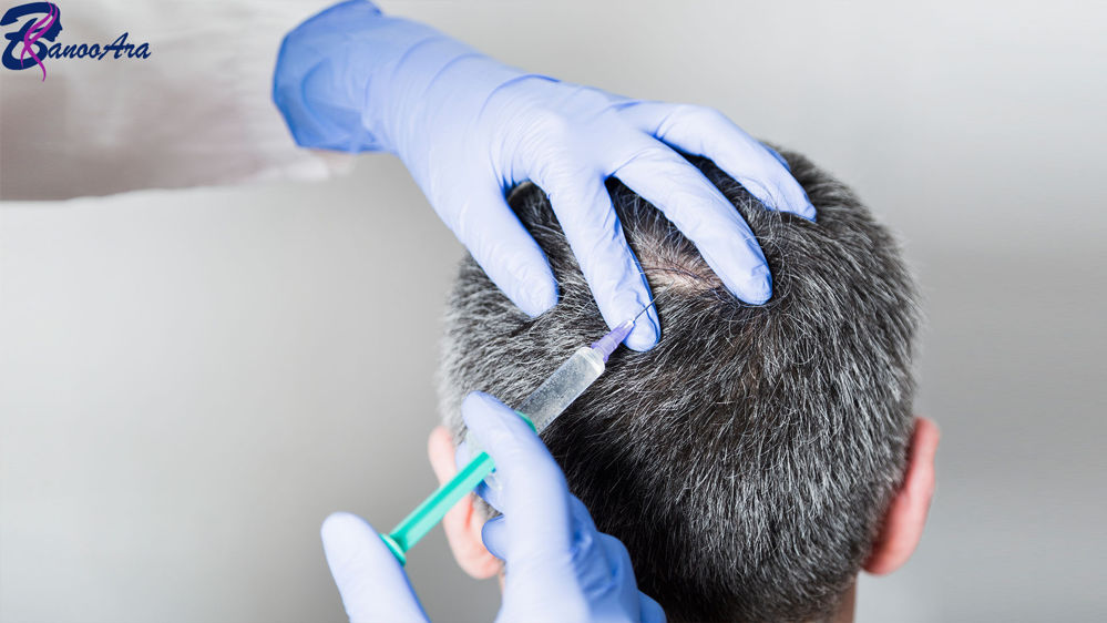 مزوتراپی و درمان ریزش مو: